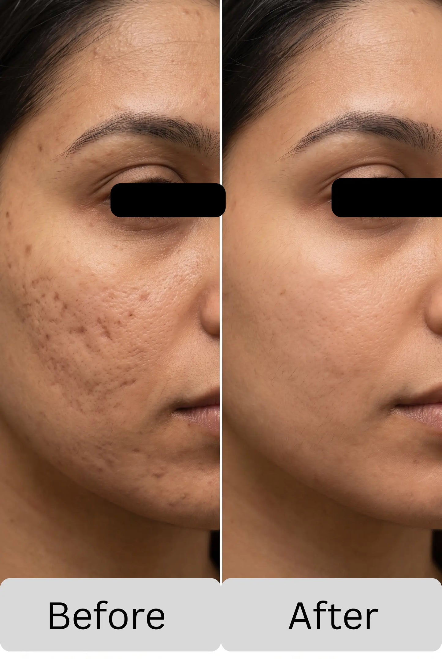 Zameora™ Advanced Scar Gel