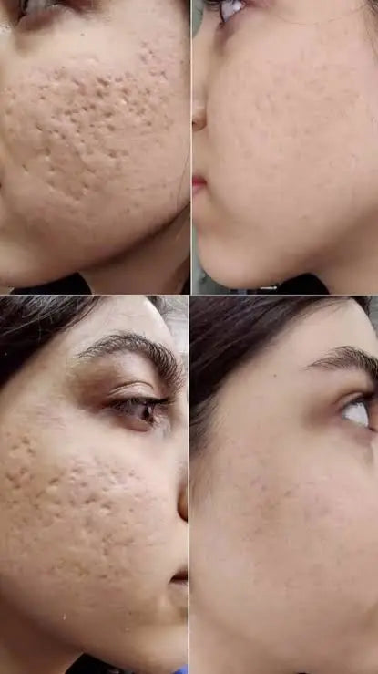 Zameora™ Advanced Scar Gel