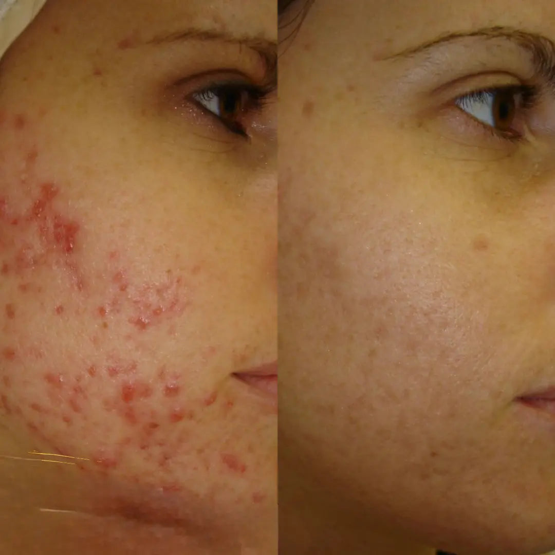 Zameora™ Advanced Scar Gel