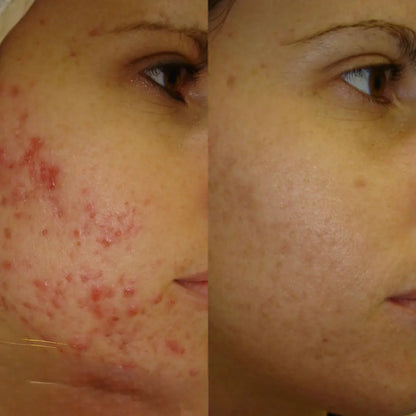 Zameora™ Advanced Scar Gel